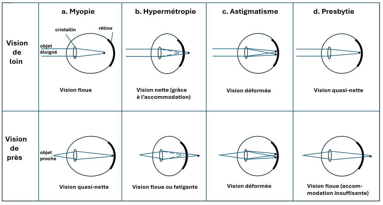 image Les differents troubles visuels
